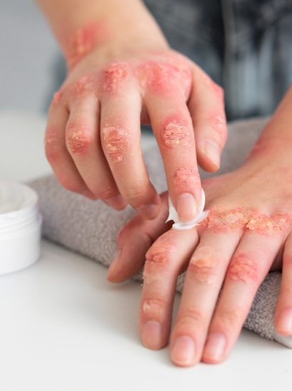 Natural Remedies for Hives in Singapore