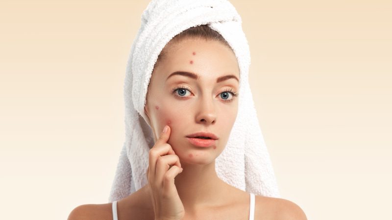 Best Skincare Routine for Acne