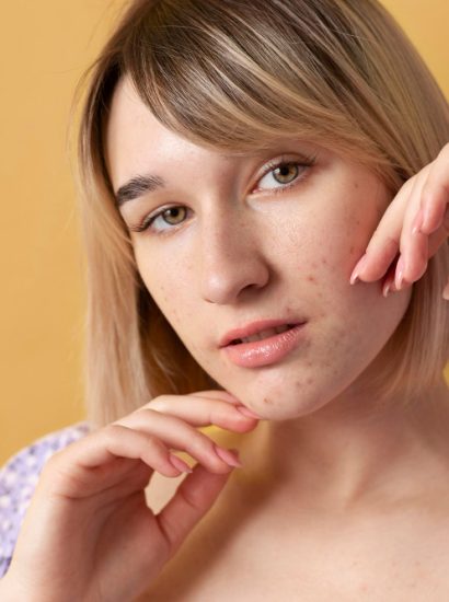 How to Treat Acne Naturally