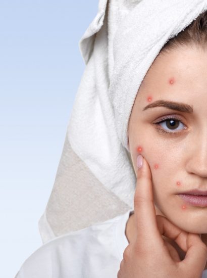 Skincare for Acne Scars