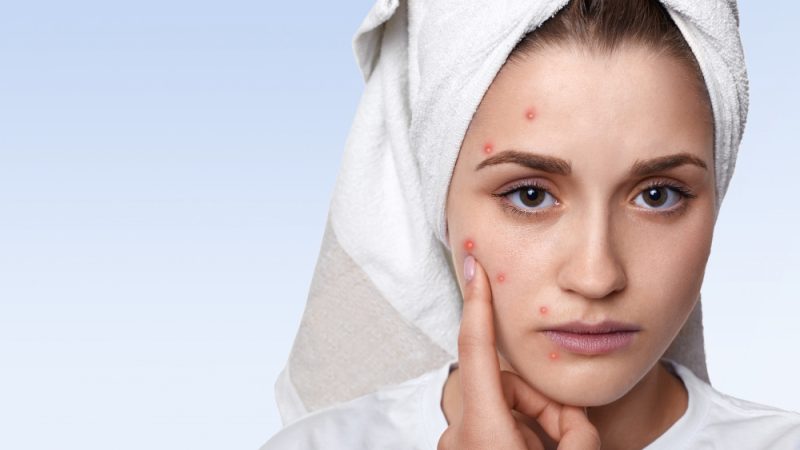 Skincare for Acne Scars