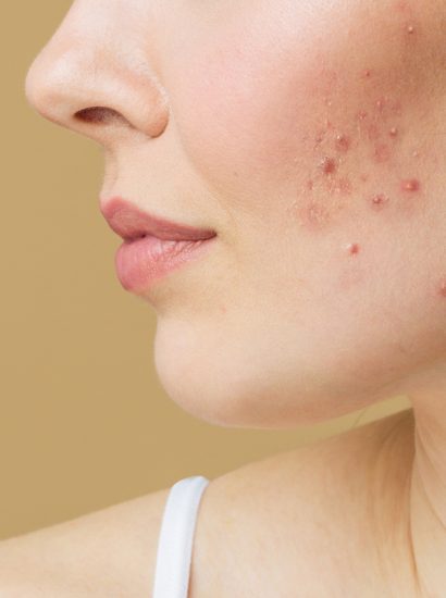 Skincare for Hormonal Acne