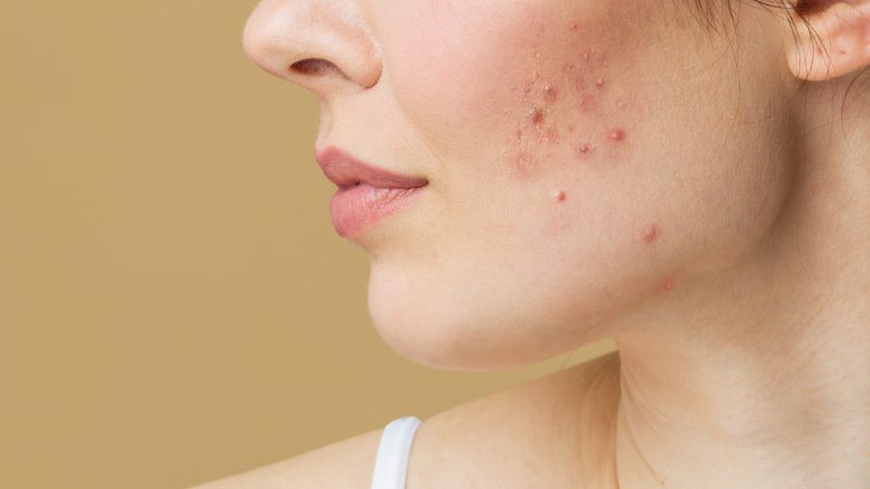 Skincare for Hormonal Acne