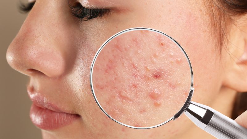 Acne Treatment Singapore