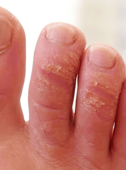 What Does Urea Do for Skin