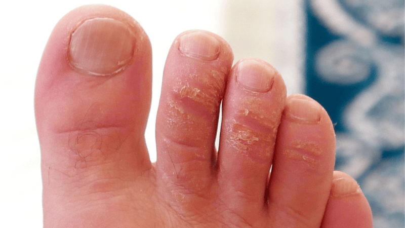 What Does Urea Do for Skin