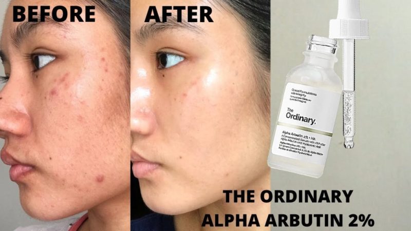 Alpha Arbutin Benefits
