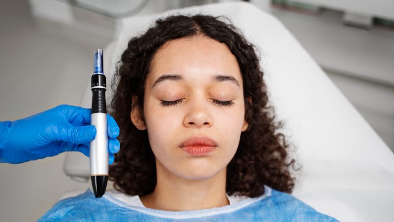 Microneedling for Scars