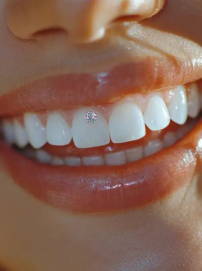 How Long Do Tooth Gems Last