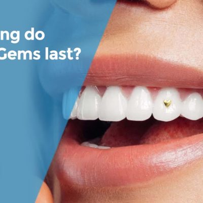 Tooth Gems That Actually Stay
