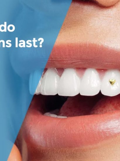 Tooth Gems That Actually Stay